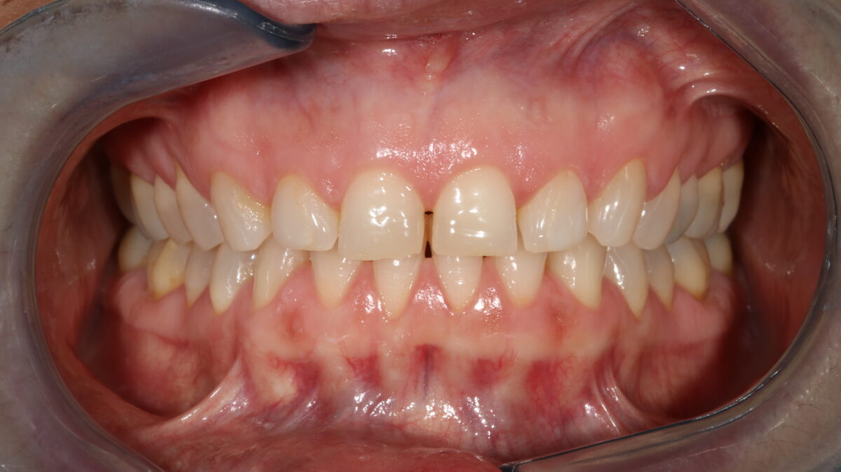 Tratamiento de blanqueamiento dental antes. 